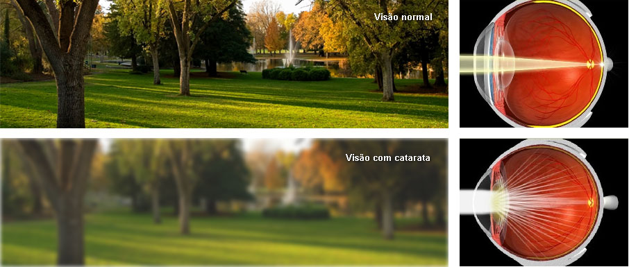 Imagem comparativa entre visão normal e visão com catarata